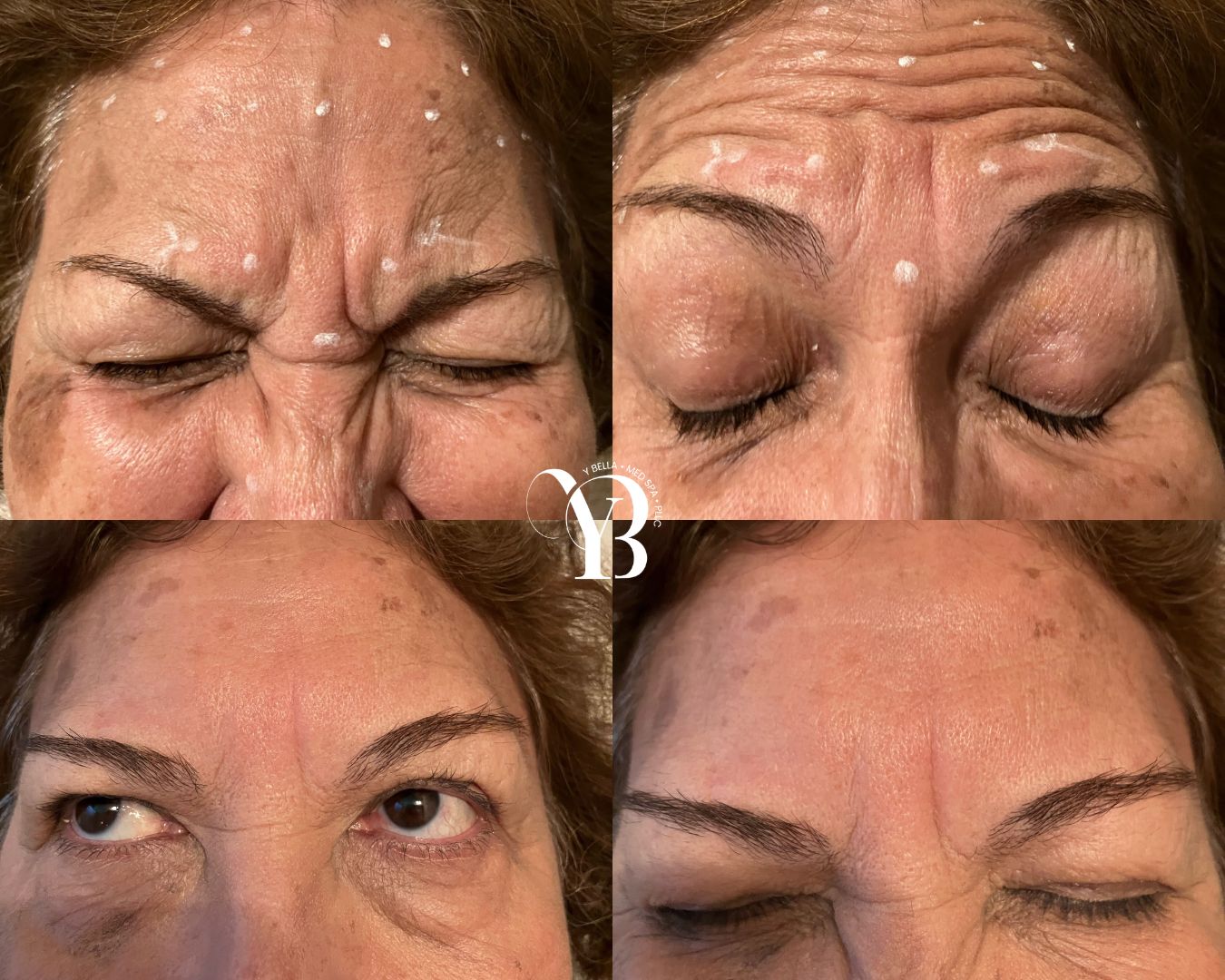 wrinkle reduction san antonio med spa