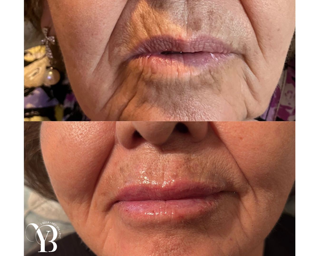 smile lines wrinkles reduction san antonio