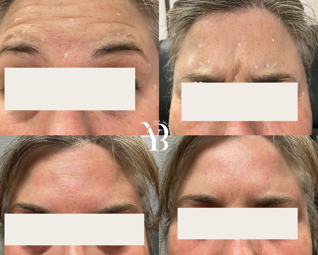 wrinkle reduction san antonio med spa