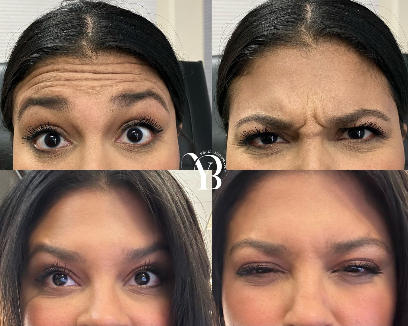 wrinkle reduction san antonio med spa