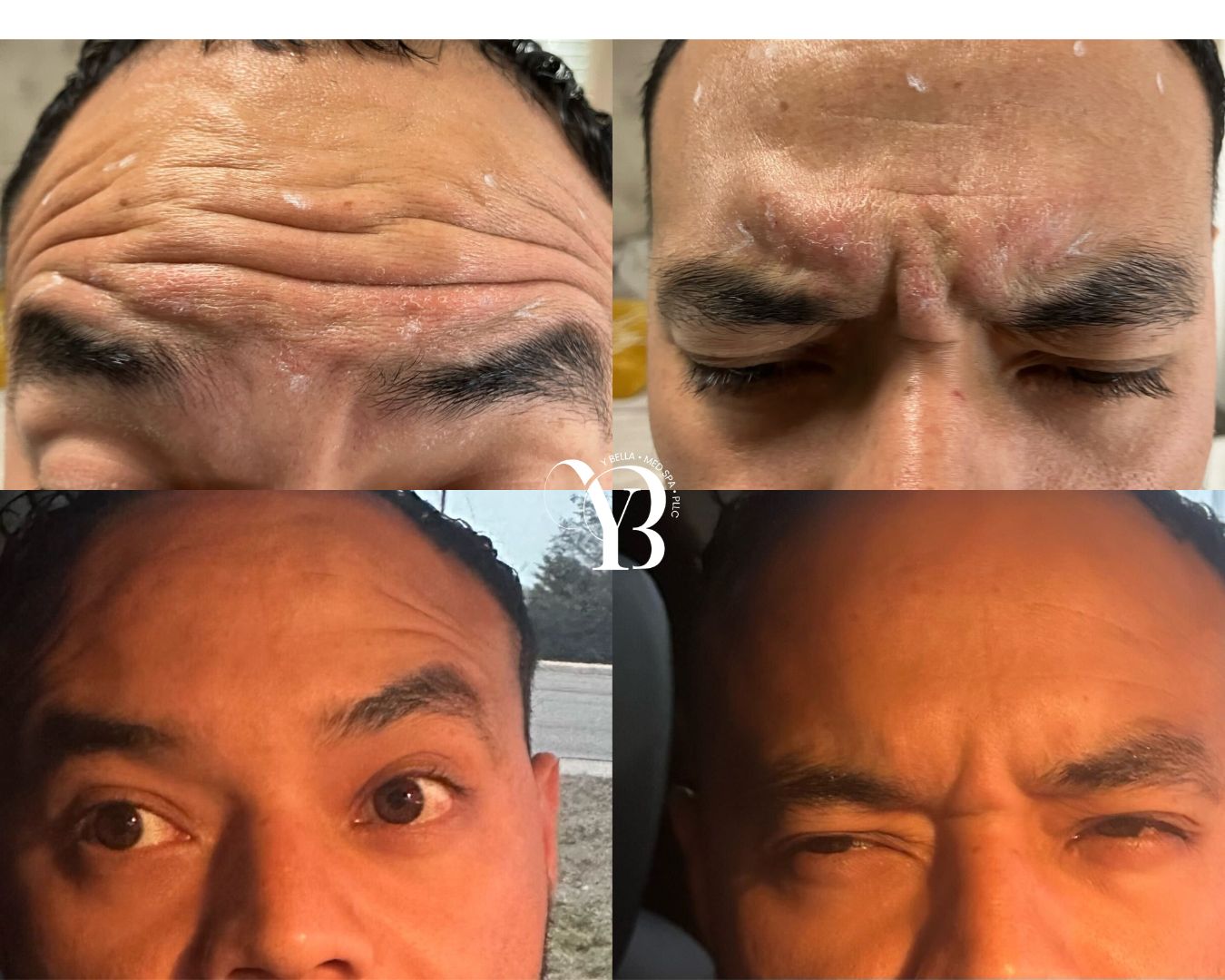 forehead wrinkles injectables