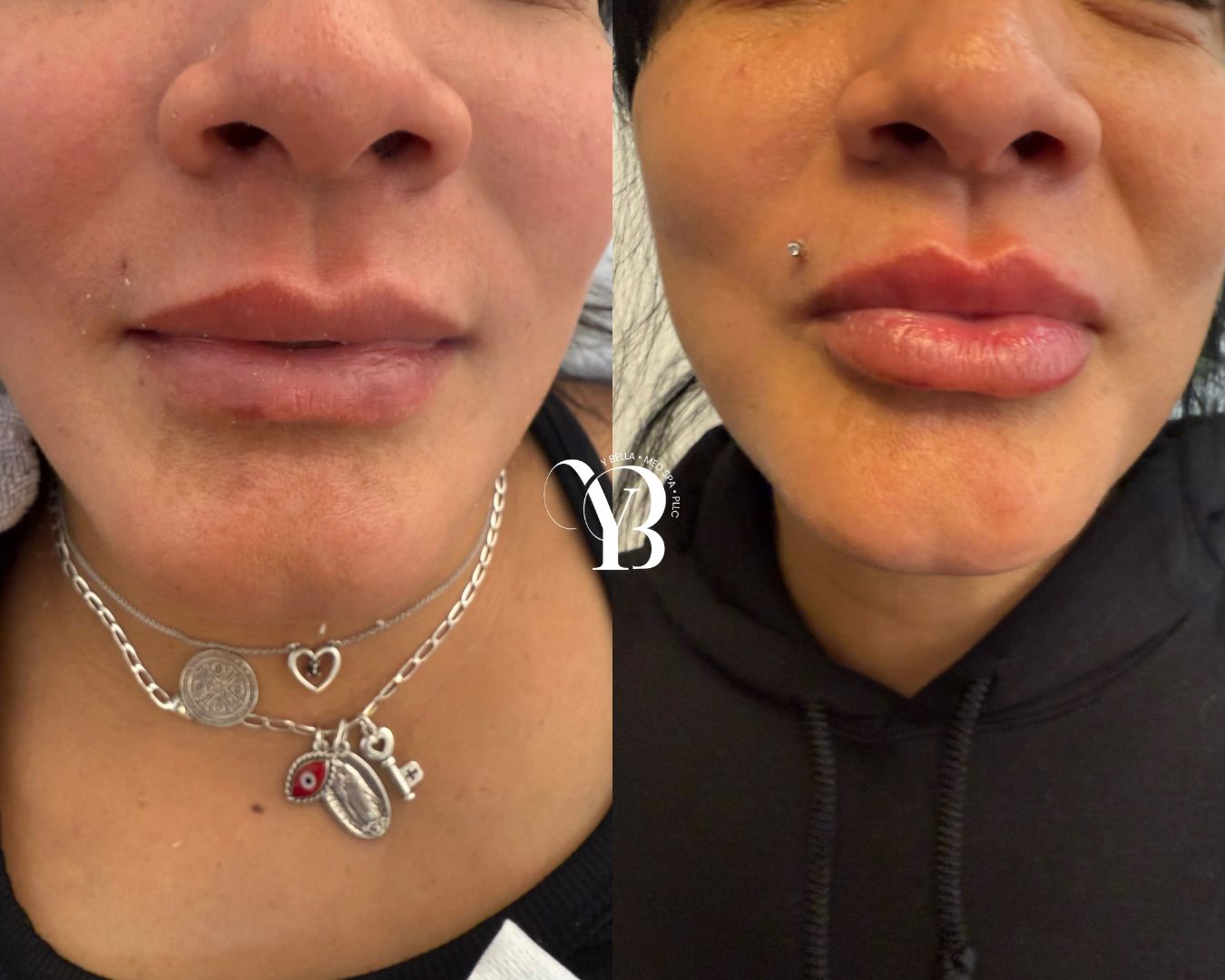 before and after injectables san antonio5