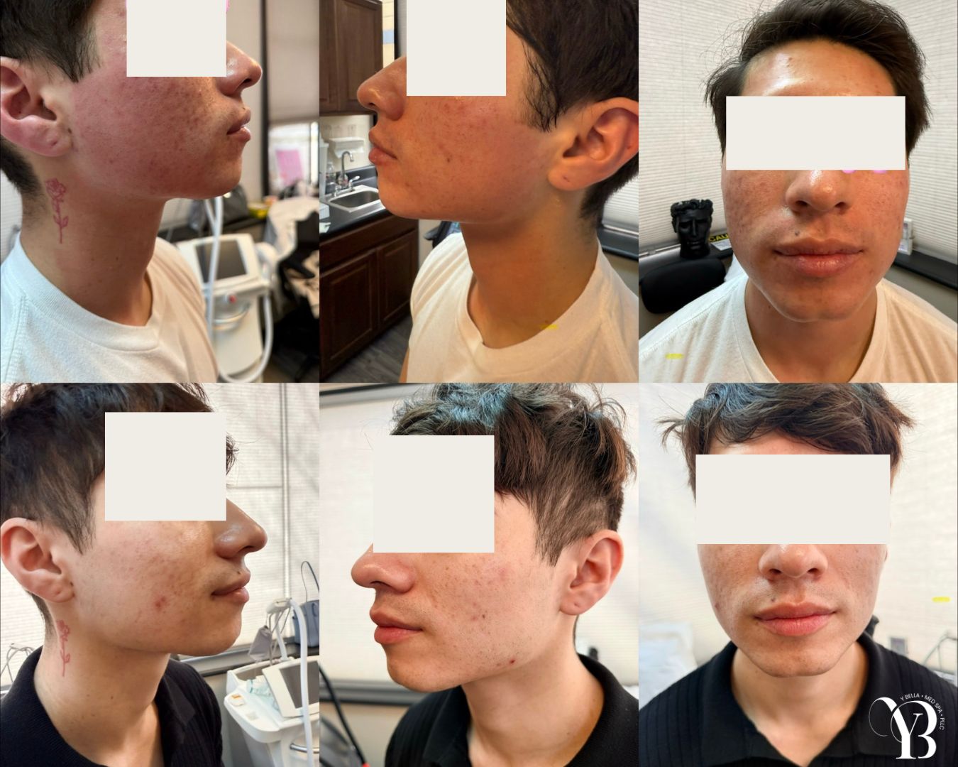 before and after injectables san antonio ybella med spa