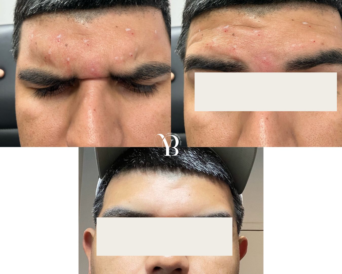 forehead before and after injectables treatment