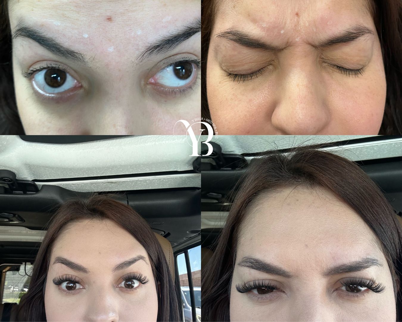 before and after injectables san antonio forehead