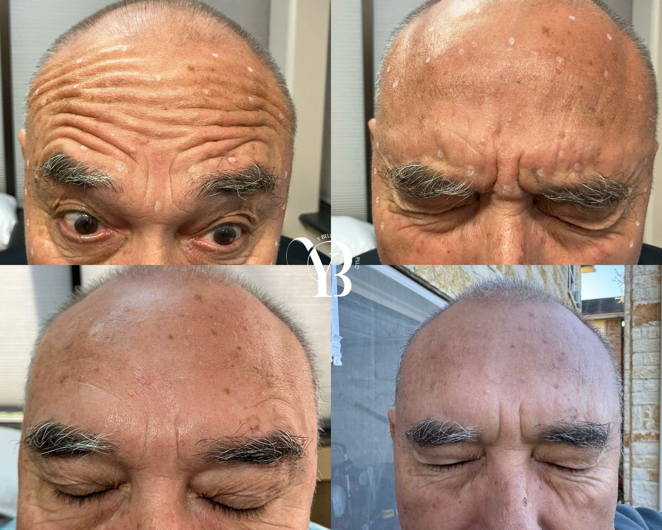 forehead wrinkles injectables